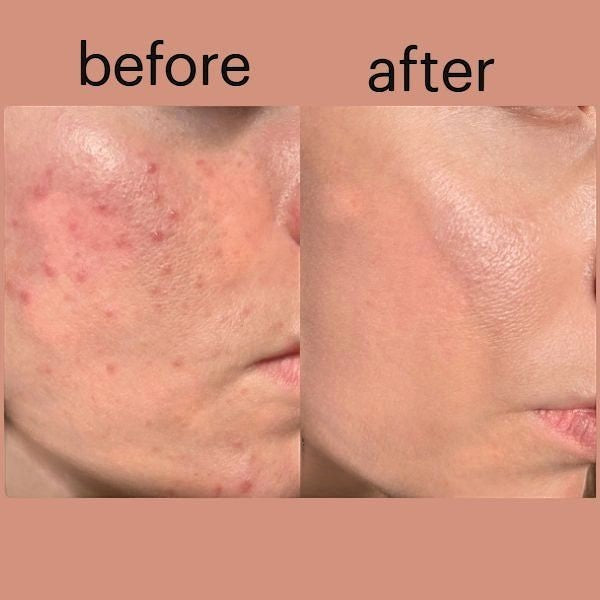 Super White Natural skincare before and after results showing reduced acne marks and smoother skin texture.