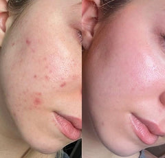 Super White Natural skincare results showing a clear improvement in skin texture and acne marks after using serum bundle